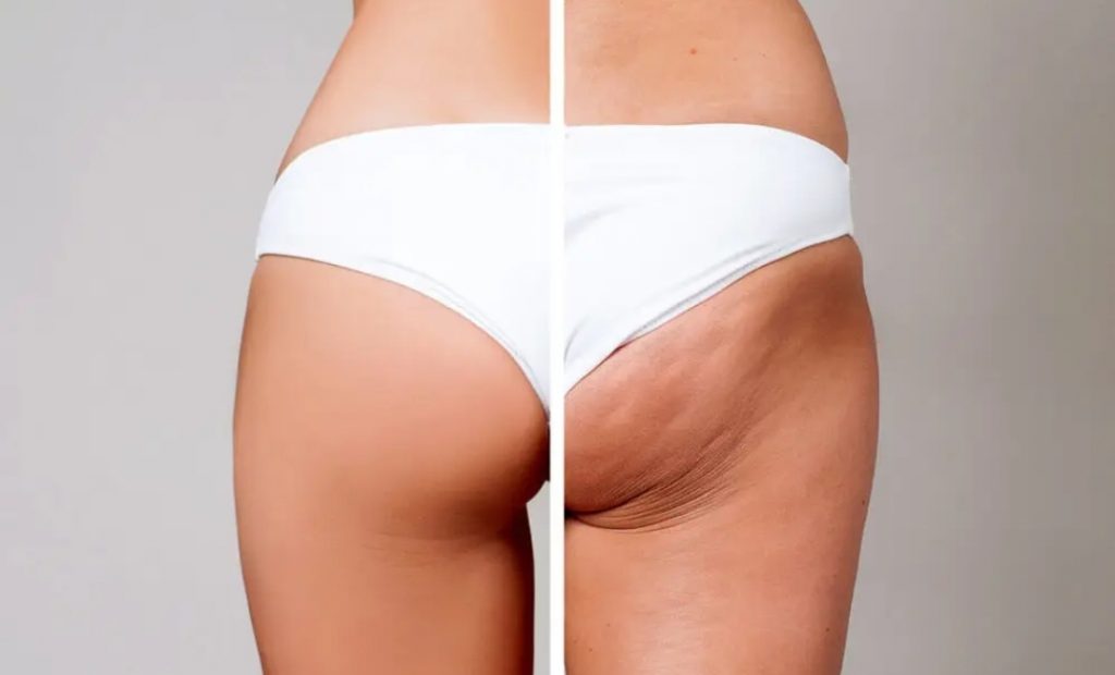 un prima e dopo del massaggio endodermico che riduce la cellulite